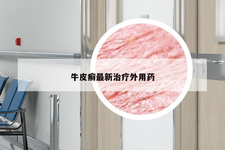 牛皮癣最新治疗外用药