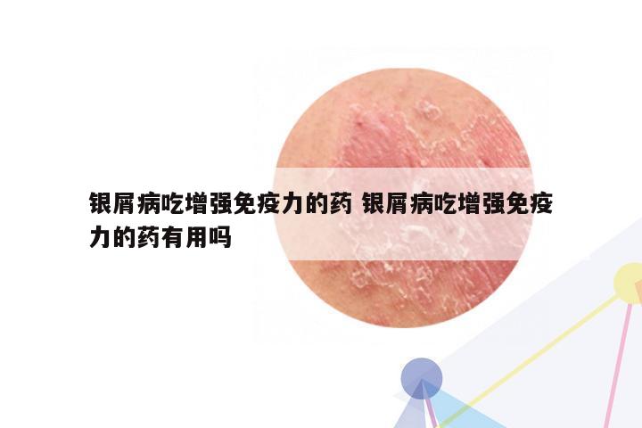 银屑病吃增强免疫力的药 银屑病吃增强免疫力的药有用吗