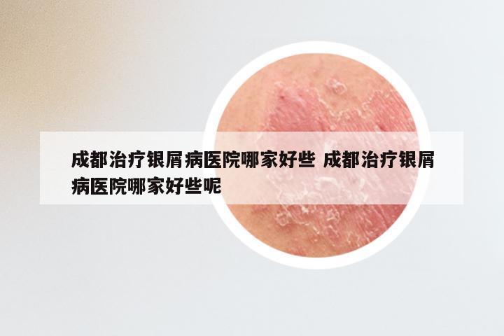 成都治疗银屑病医院哪家好些 成都治疗银屑病医院哪家好些呢