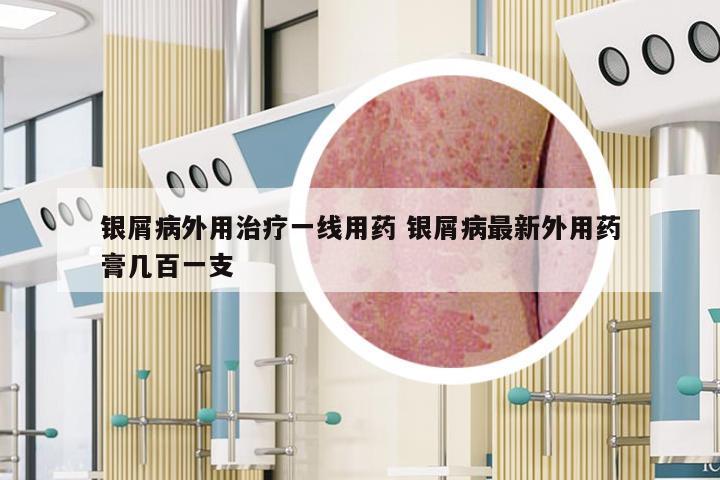银屑病外用治疗一线用药 银屑病最新外用药膏几百一支