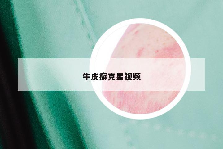 牛皮癣克星视频
