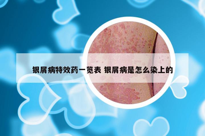 银屑病特效药一览表 银屑病是怎么染上的