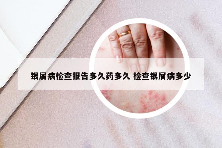 银屑病检查报告多久药多久 检查银屑病多少