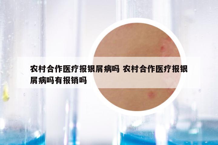 农村合作医疗报银屑病吗 农村合作医疗报银屑病吗有报销吗