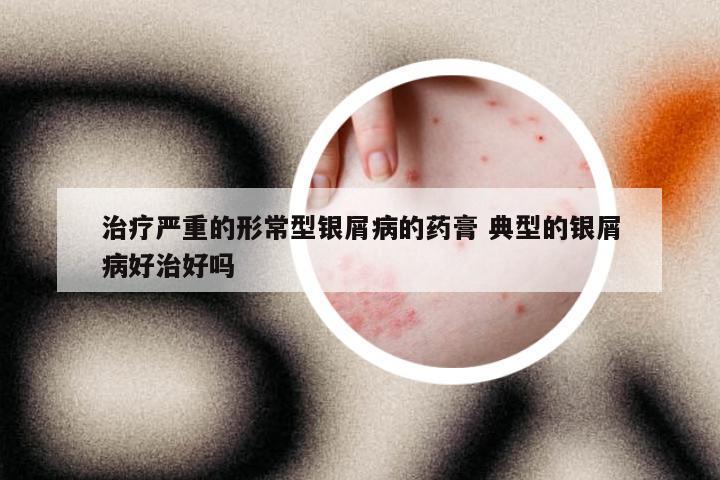 治疗严重的形常型银屑病的药膏 典型的银屑病好治好吗