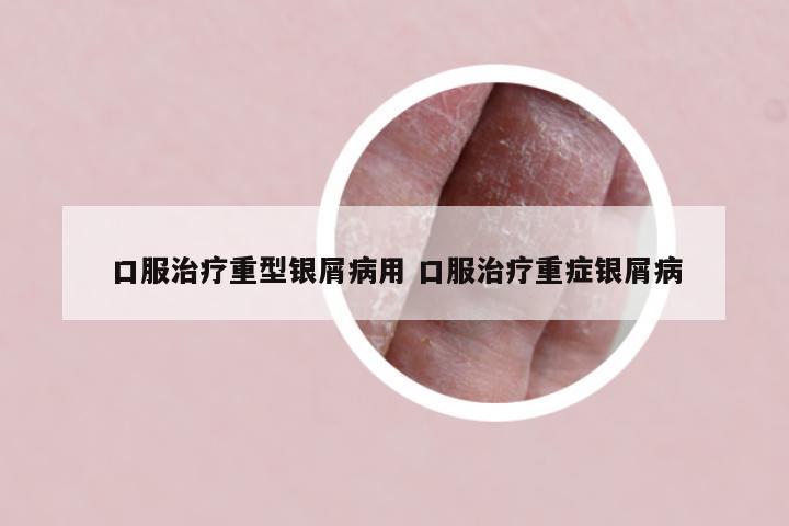 口服治疗重型银屑病用 口服治疗重症银屑病