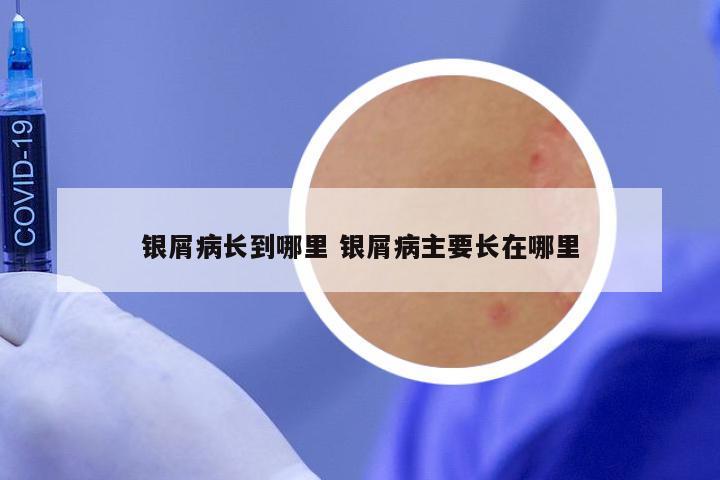 银屑病长到哪里 银屑病主要长在哪里