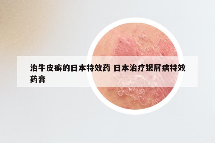 治牛皮癣的日本特效药 日本治疗银屑病特效药膏