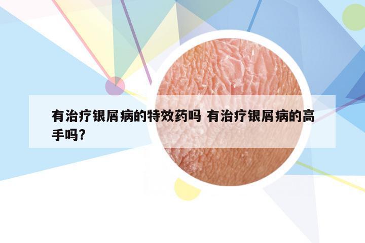 有治疗银屑病的特效药吗 有治疗银屑病的高手吗?