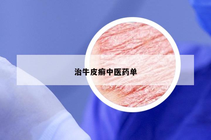 治牛皮癣中医药单