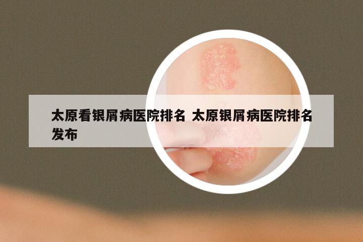 太原看银屑病医院排名 太原银屑病医院排名发布