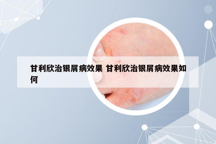甘利欣治银屑病效果 甘利欣治银屑病效果如何
