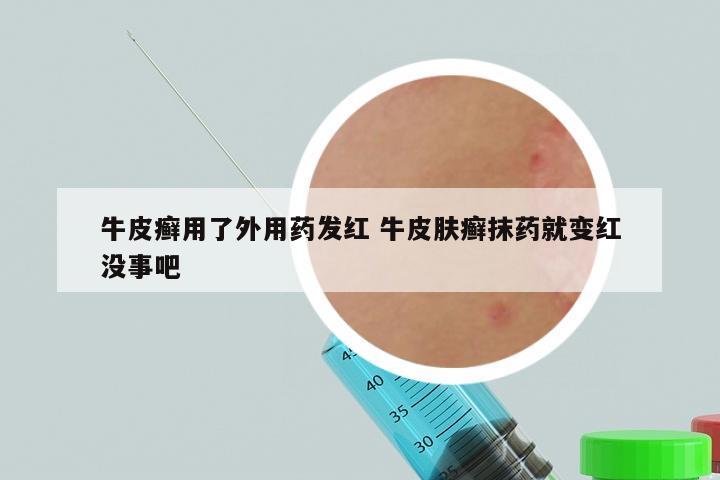 牛皮癣用了外用药发红 牛皮肤癣抹药就变红没事吧
