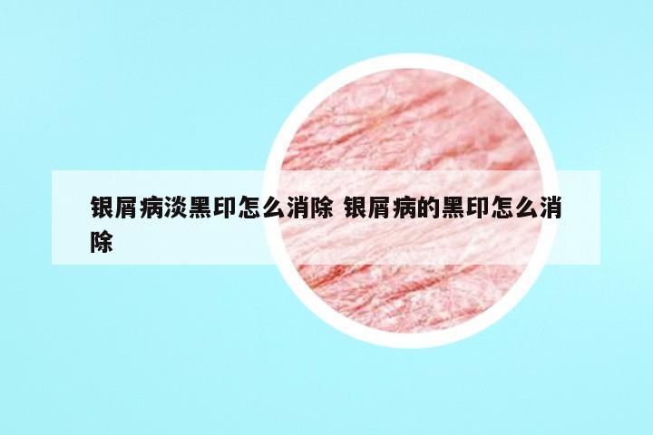 银屑病淡黑印怎么消除 银屑病的黑印怎么消除