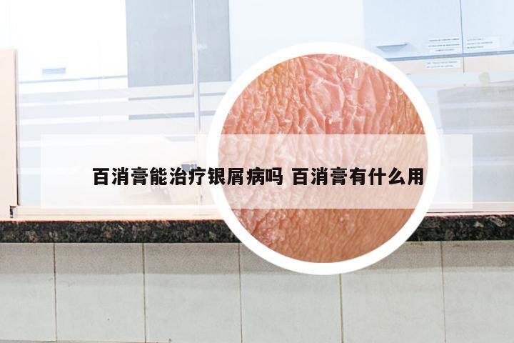百消膏能治疗银屑病吗 百消膏有什么用