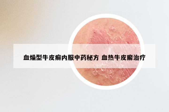 血燥型牛皮癣内服中药秘方 血热牛皮廨治疗
