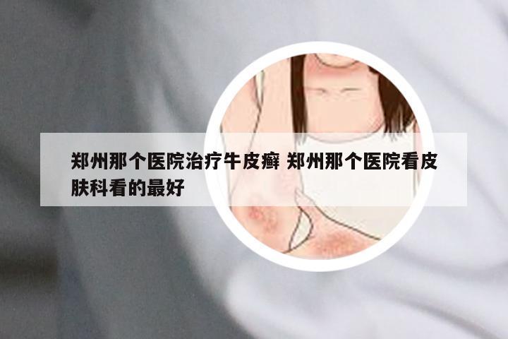 郑州那个医院治疗牛皮癣 郑州那个医院看皮肤科看的最好