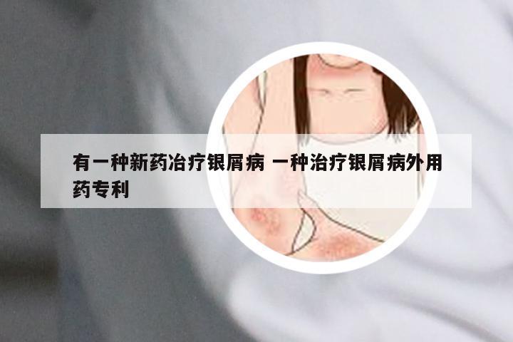 有一种新药冶疗银屑病 一种治疗银屑病外用药专利