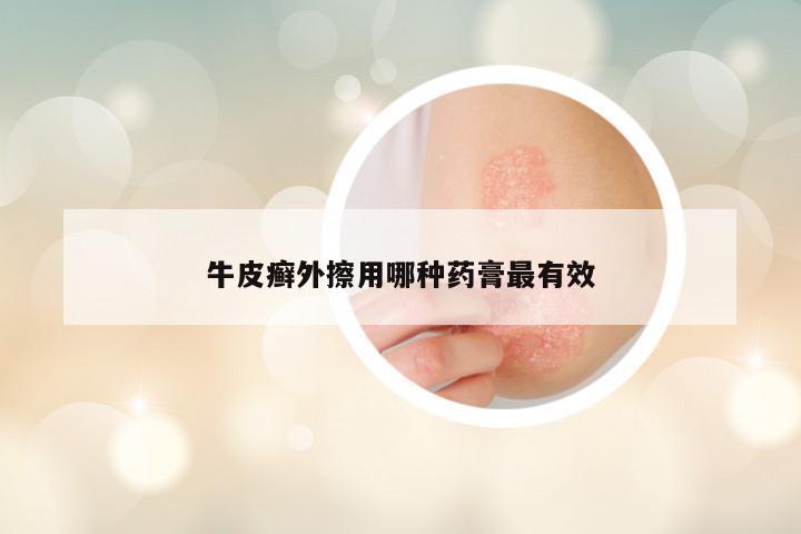 牛皮癣外擦用哪种药膏最有效