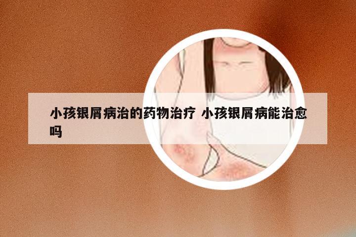小孩银屑病治的药物治疗 小孩银屑病能治愈吗