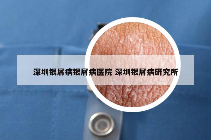 深圳银屑病银屑病医院 深圳银屑病研究所