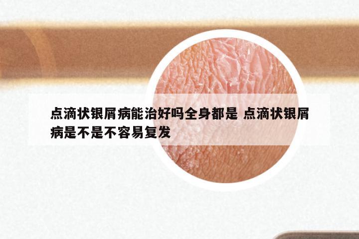 点滴状银屑病能治好吗全身都是 点滴状银屑病是不是不容易复发