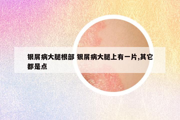 银屑病大腿根部 银屑病大腿上有一片,其它都是点