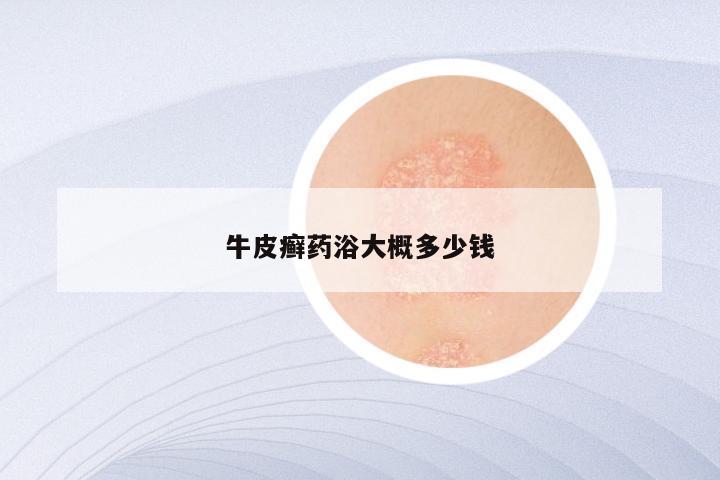 牛皮癣药浴大概多少钱