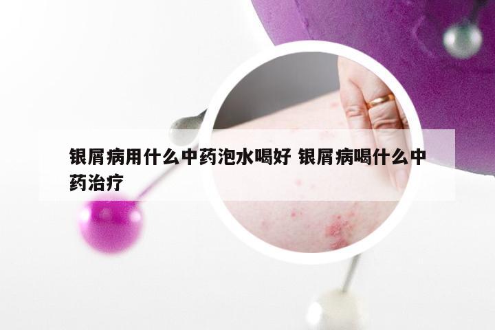 银屑病用什么中药泡水喝好 银屑病喝什么中药治疗