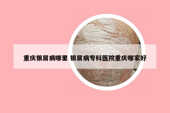 重庆银屑病哪里 银屑病专科医院重庆哪家好