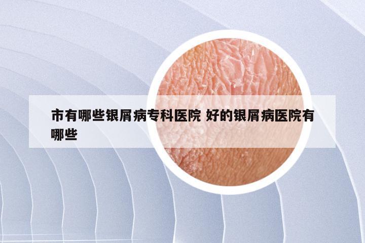 市有哪些银屑病专科医院 好的银屑病医院有哪些