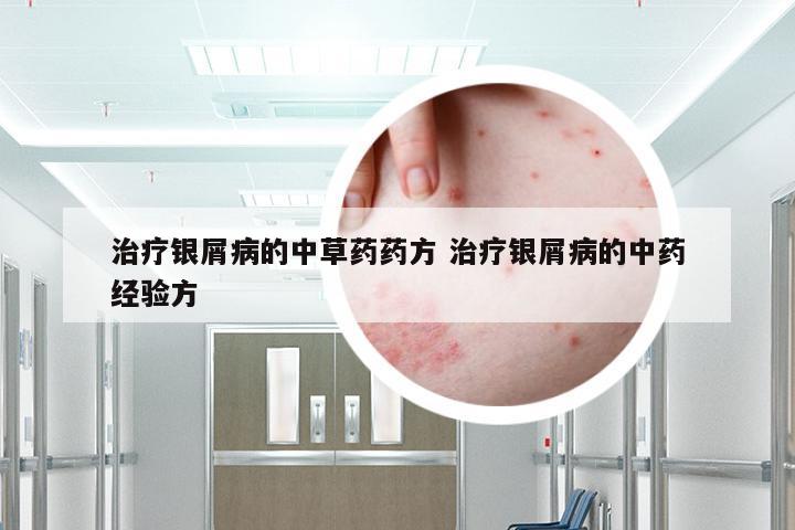 治疗银屑病的中草药药方 治疗银屑病的中药经验方