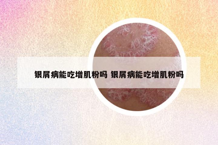 银屑病能吃增肌粉吗 银屑病能吃增肌粉吗