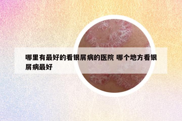 哪里有最好的看银屑病的医院 哪个地方看银屑病最好