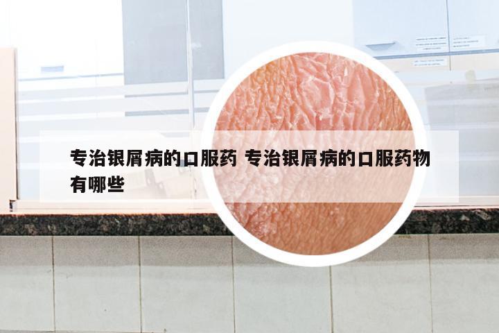 专治银屑病的口服药 专治银屑病的口服药物有哪些