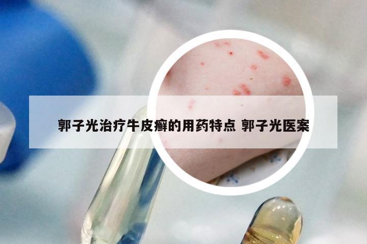 郭子光治疗牛皮癣的用药特点 郭子光医案