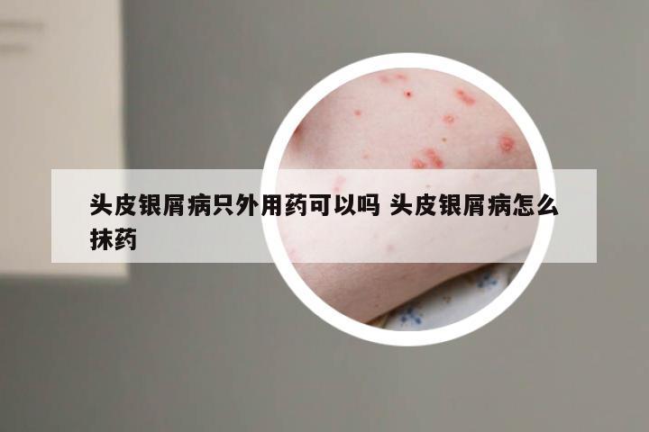 头皮银屑病只外用药可以吗 头皮银屑病怎么抹药