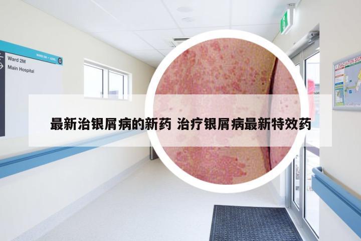 最新治银屑病的新药 治疗银屑病最新特效药