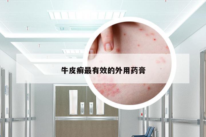 牛皮癣最有效的外用药膏