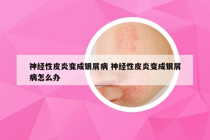 神经性皮炎变成银屑病 神经性皮炎变成银屑病怎么办
