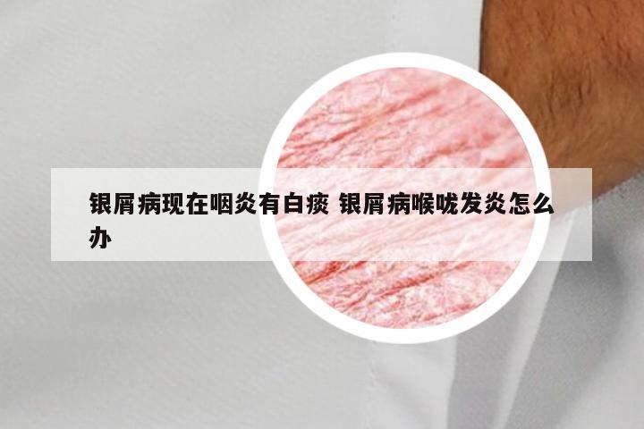 银屑病现在咽炎有白痰 银屑病喉咙发炎怎么办