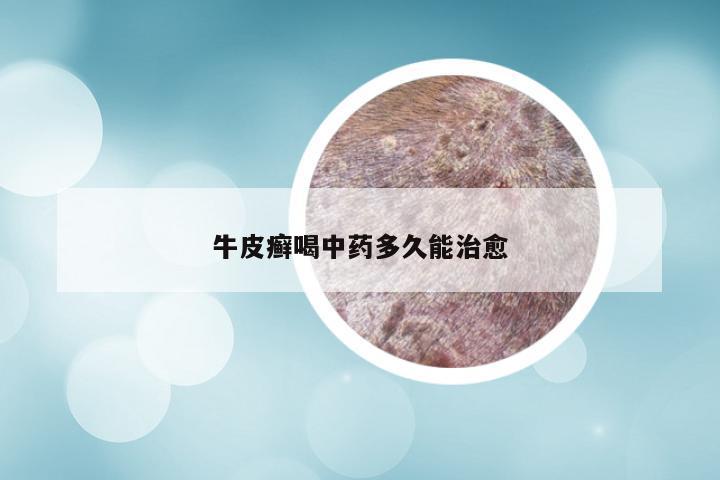 牛皮癣喝中药多久能治愈