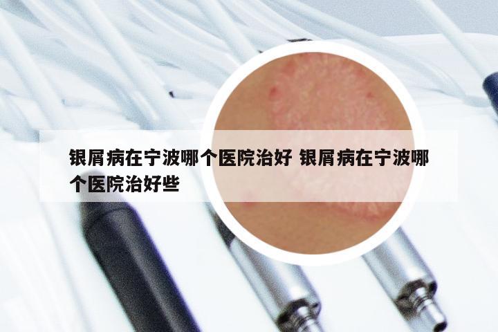 银屑病在宁波哪个医院治好 银屑病在宁波哪个医院治好些