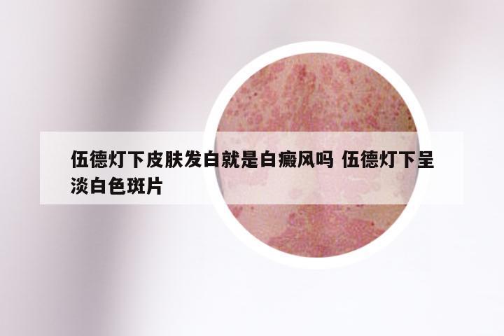伍德灯下皮肤发白就是白癜风吗 伍德灯下呈淡白色斑片