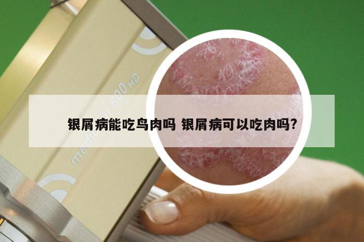 银屑病能吃鸟肉吗 银屑病可以吃肉吗?