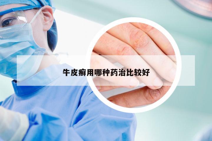 牛皮癣用哪种药治比较好