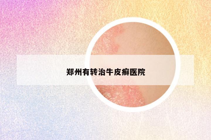 郑州有转治牛皮癣医院