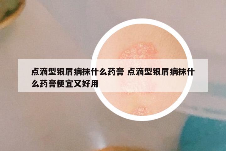 点滴型银屑病抹什么药膏 点滴型银屑病抹什么药膏便宜又好用