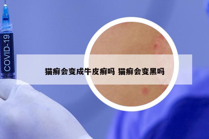猫癣会变成牛皮癣吗 猫癣会变黑吗