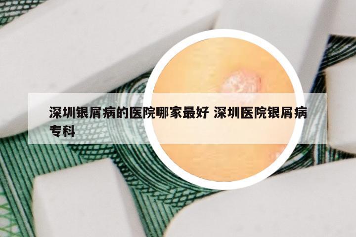 深圳银屑病的医院哪家最好 深圳医院银屑病专科
